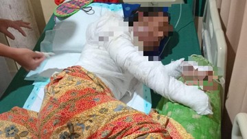 Suami di Lampung Bakar Istri yang Lagi Hamil, Korban Luka Bakar 80%